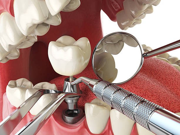 Best Emergency Treatment for Toothache in Dayton, OH